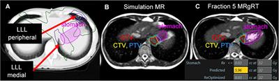 Initial clinical experience with magnetic resonance-guided radiotherapy in pediatric patients: Lessons learned from a single institution with proton therapy